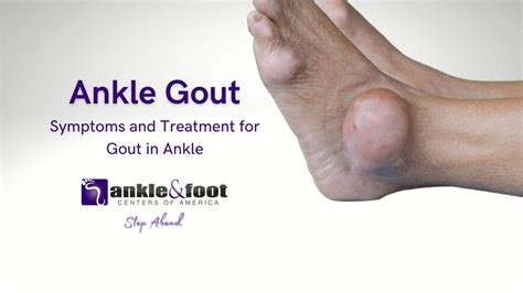 Ankle Gout - Causes, Symptoms, and Treatment in Nashville