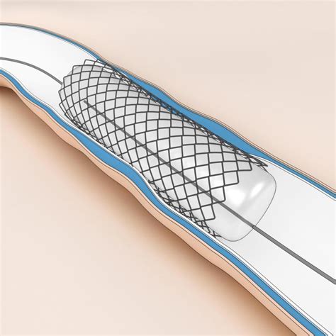 What is a Ureteric Stent? (with pictures)