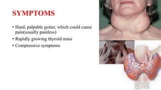 Riedel thyroiditis | PPT