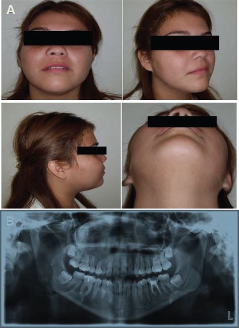 Maxillary Adenomatoid Odontogenic Tumor: Case Report in a Hospital in ...