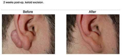 Keloid Removal ⋆ Fresno Plastic Surgery