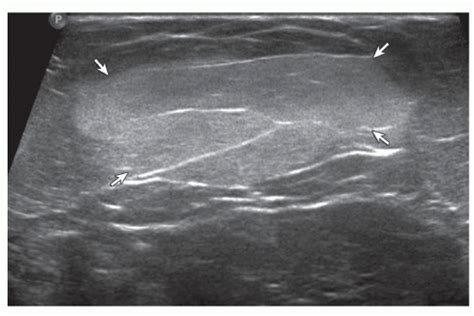 Lipoma. Ultrasound image shows oval hyperechoic subcutaneous lipoma ...