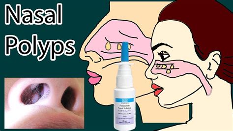 Nasal Polyps symptoms, causes and treatment - YouTube