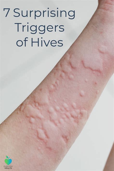 Did you know a #workout can trigger #hives? #exerciseurticaria ...