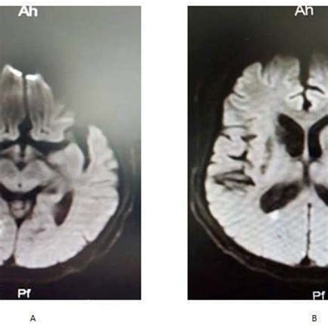 (A) MRI revealing the right cerebellar infarction. (B) Cerebral MRI ...