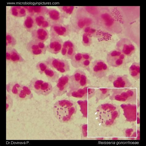 Gonococcus (Neisseria gonorrhoeae) Gram-stain and cell morphology. A ...