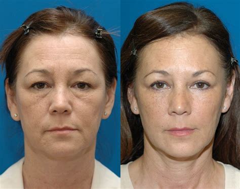 Eyelid Lift Seattle | Blepharoplasty Specialist | Cosmetic Eyelid Surgery