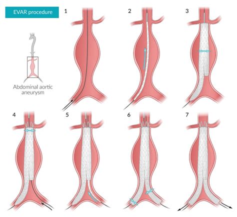 Thoracic Aortic Aneurysm Classification