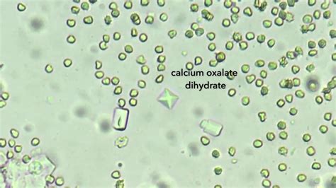 Calcium Oxalate Dihydrate Crystals In Urine