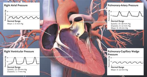 Right Heart Cath Pressure Waveforms