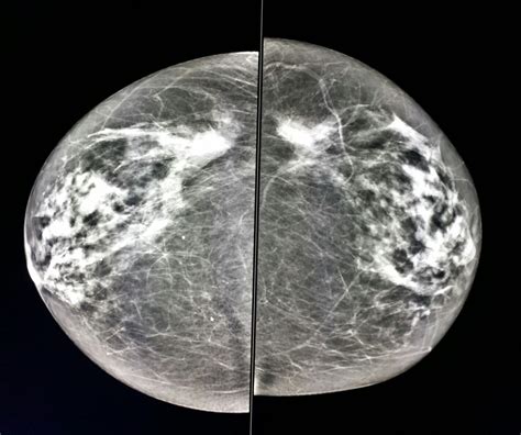 Normal And Abnormal Mammograms