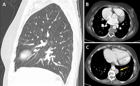 Lung Fissure Ct Scan