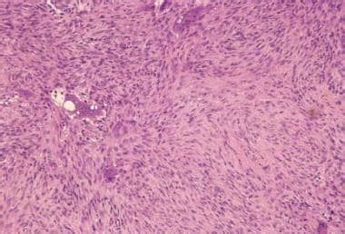 Fibrous Cortical Defect (Nonossifying Fibroma) Workup: Plain ...