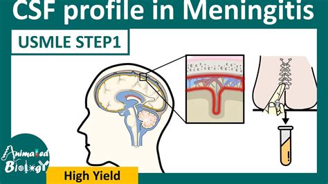 CSF analysis in Meningitis | Easy way to remember CSF analysis in ...