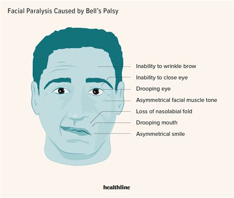 Bell’s Palsy: Causes, Symptoms, Diagnosis, Treatment, Outlook