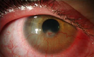 Phlyctenular Keratoconjunctivitis. EyeRounds.org - Ophthalmology - The ...