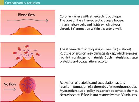 Diagnostic Criteria for Acute Myocardial Infarction: Cardiac troponins ...