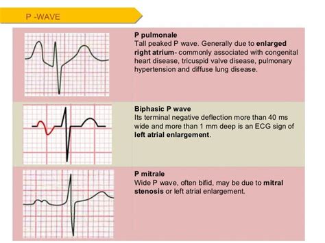 P wave | P wave, Tricuspid valve, Waves