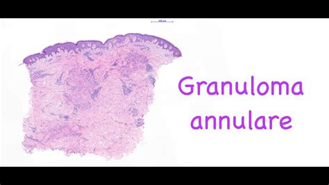 Granuloma Annulare Histopathology