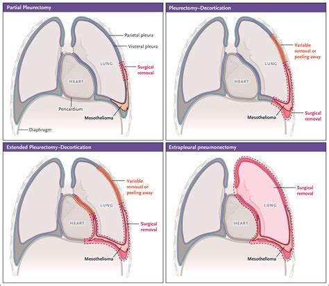 Perspectives on the Treatment of Malignant Pleural Mesothelioma | NEJM