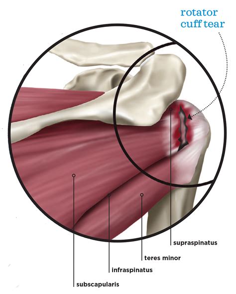 Rotator Cuff Anatomy - IDEA Health & Fitness Association