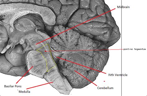 Medial Pontine Syndrome