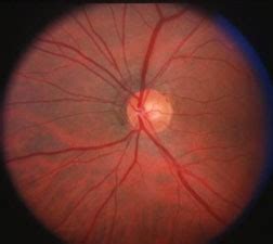 Optic Nerve Atrophy - American Association for Pediatric Ophthalmology ...