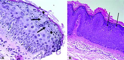 Histopathologic findings in epidermodysplasia verruciformis and ...