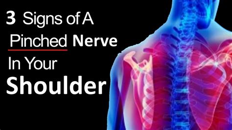 Pinched Nerve in Shoulder: Symptoms, Causes, and Effective Treatments