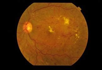 Retinopathy: Valsalva Retinopathy Treatment