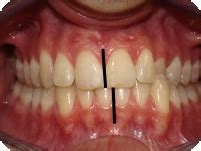 Common Orthodontic Problems | Some Common Alignment Issues