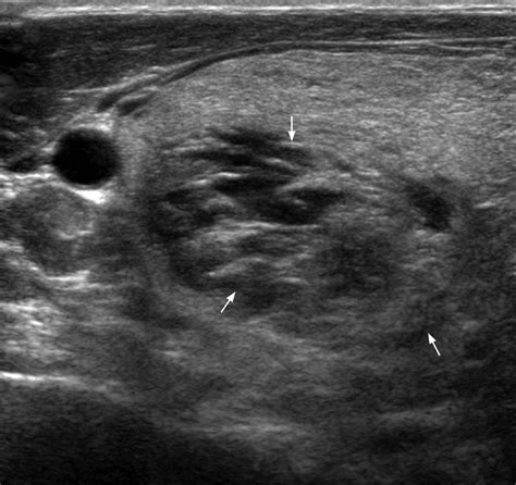 Thyroid Goiter Ultrasound