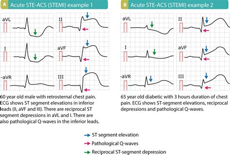 STEMI (ST Elevation Myocardial Infarction): diagnosis, criteria, ECG ...