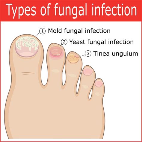 Fungal Infection Nails