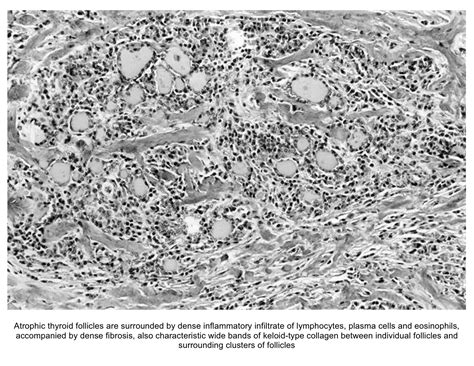 Pathology Outlines - Riedel thyroiditis