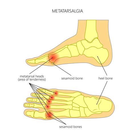 Metatarsalgia — Haag Foot & Ankle