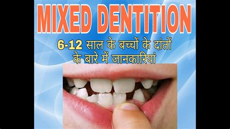 Mixed Dentition | 6-12 years time period of teeth development | ugly ...