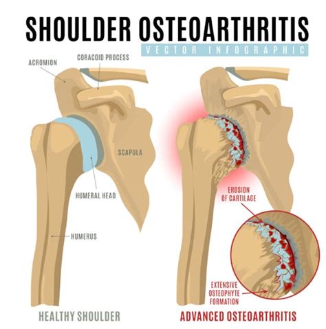 Shoulder Arthritis Treatment | Las Vegas, Lake Havasu, Mesquite Nevada