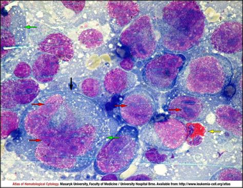 Anaplastic large-cell lymphoma, ALK-positive - CELL - Atlas of ...