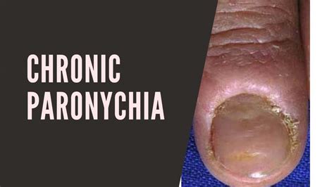 Chronic Paronychia: Causes, Symptoms, Treatment, And Prevention » 2023