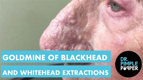 A Goldmine of Blackheads & Whiteheads - Dr. Pimple Popper