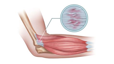 Tennis Elbow Treatment & Exercises - Gen Physio Blog