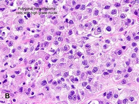 American Urological Association - Malignant Mesothelioma (MM)