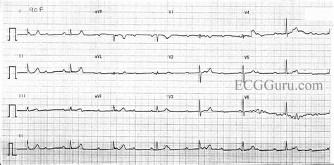 ECG Complete Heart Block Strip