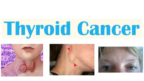 Thyroid Cancer (Papillary, Follicular, Medullary & Anaplastic ...