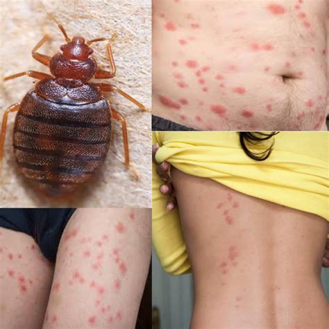 What Do Bed Bug Bites Look Like? (Pictured) - Public Health