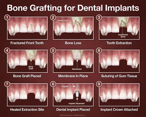 Bone Grafting - Tallahassee and Marianna, FL - Maxillofacial