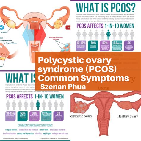 Common Symptoms of PCOS – Best Acupuncture Hamilton NZ