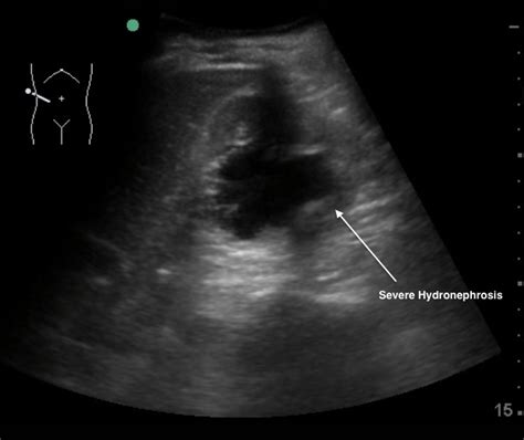 Severe Hydronephrosis | Emory School of Medicine