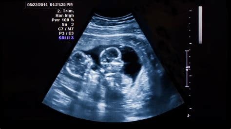 20 Weeks Pregnant With Twins Ultrasound